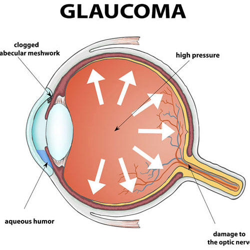 glaucoma